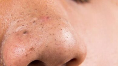 Nose Blackheads: नाक के ब्लैकहेड्स को बिना पैसे खर्च किए हटाएं, जानिए कैसे