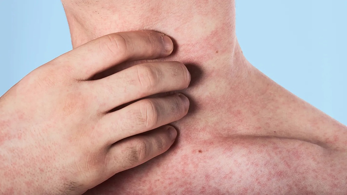 Measles: अमेरिका में बढ़ रहा इस वायरस का खतरा, शरीर में दिखाई देने वाले कुछ लक्षणों से सावधान!