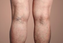 Varicose Veins कितनी खतरनाक? क्यों होती है ये बीमारी? जानिए इसके बारे में सबकुछ