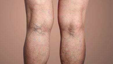 Varicose Veins कितनी खतरनाक? क्यों होती है ये बीमारी? जानिए इसके बारे में सबकुछ
