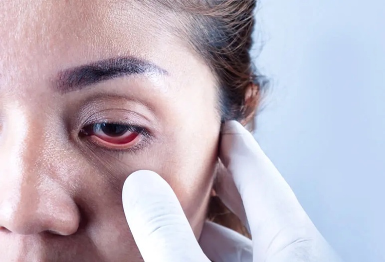 Lucknow: स्थायी अंधत्व का प्रमुख कारण है ग्लूकोमा, नियमित रूप से नेत्र परीक्षण कराना जरूरी