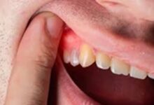 Oral Hygiene: मसूड़े की सड़न बन सकती है कमजोर हड्डियों का कारण, जानें कैसे बढ़ाएं विटामिन और कैल्शियम?