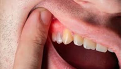 Oral Hygiene: मसूड़े की सड़न बन सकती है कमजोर हड्डियों का कारण, जानें कैसे बढ़ाएं विटामिन और कैल्शियम?