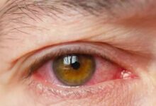 Alert! आंखों के नीचे रहती है सूजन, हो सकती है किडनी से जुड़ी ये बीमारी