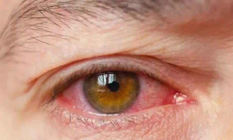 Alert! आंखों के नीचे रहती है सूजन, हो सकती है किडनी से जुड़ी ये बीमारी