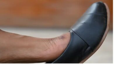 Shoe Bite Treatment: जूते-चप्पल ने काट लिया तो क्या करें? समय पर इलाज जरूरी