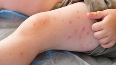 Measles: बांग्लादेश में खसरे से 250 से अधिक मौत, WHO ने सभी के लिए जारी किया रेड अलर्ट