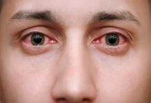 Eyes Care: चिलचिलाती गर्मी से आंखों में होने लगी है जलन? जानिए क्या है इसका सलूशन