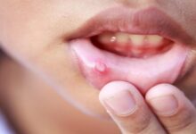 Mouth Ulcers: तुरंत चाहिए मुंह के छालों से राहत? अपनाएं ये घरेलू उपाय