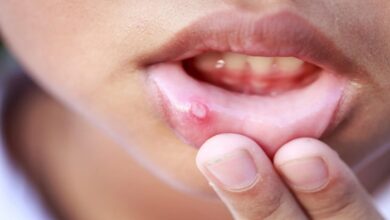 Mouth Ulcers: तुरंत चाहिए मुंह के छालों से राहत? अपनाएं ये घरेलू उपाय