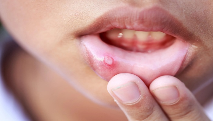 Mouth Ulcers: तुरंत चाहिए मुंह के छालों से राहत? अपनाएं ये घरेलू उपाय