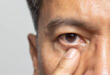 Eye Twitching: बार-बार फड़क रही है आंख? जानें कारण और राहत के उपाय