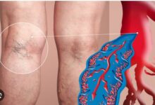 Alert! पैरों में नसों की दिक्कत ले सकती है बड़ा रूप, जानिए Chronic Venous Disease के बारे में