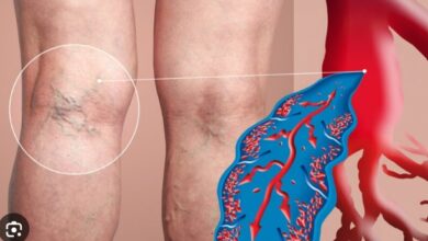 Alert! पैरों में नसों की दिक्कत ले सकती है बड़ा रूप, जानिए Chronic Venous Disease के बारे में